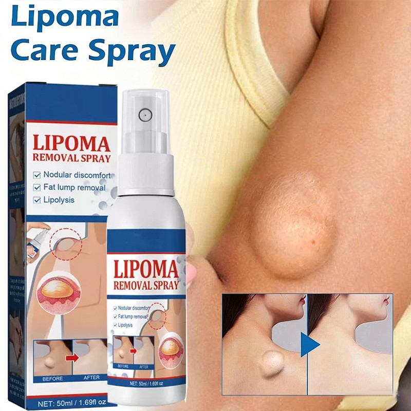 50ML Lipomheilung Reduction Spray, Instant LumpFree Lipoma Removal Spray