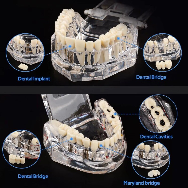 Medical Pathological Extrusion Missing Teeth Model Dental Teaching Teeth Model