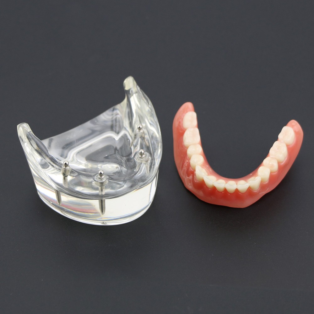 Dental Typodont Lower Teeth Demo Study Model Overdenture Inferior 4 Implants