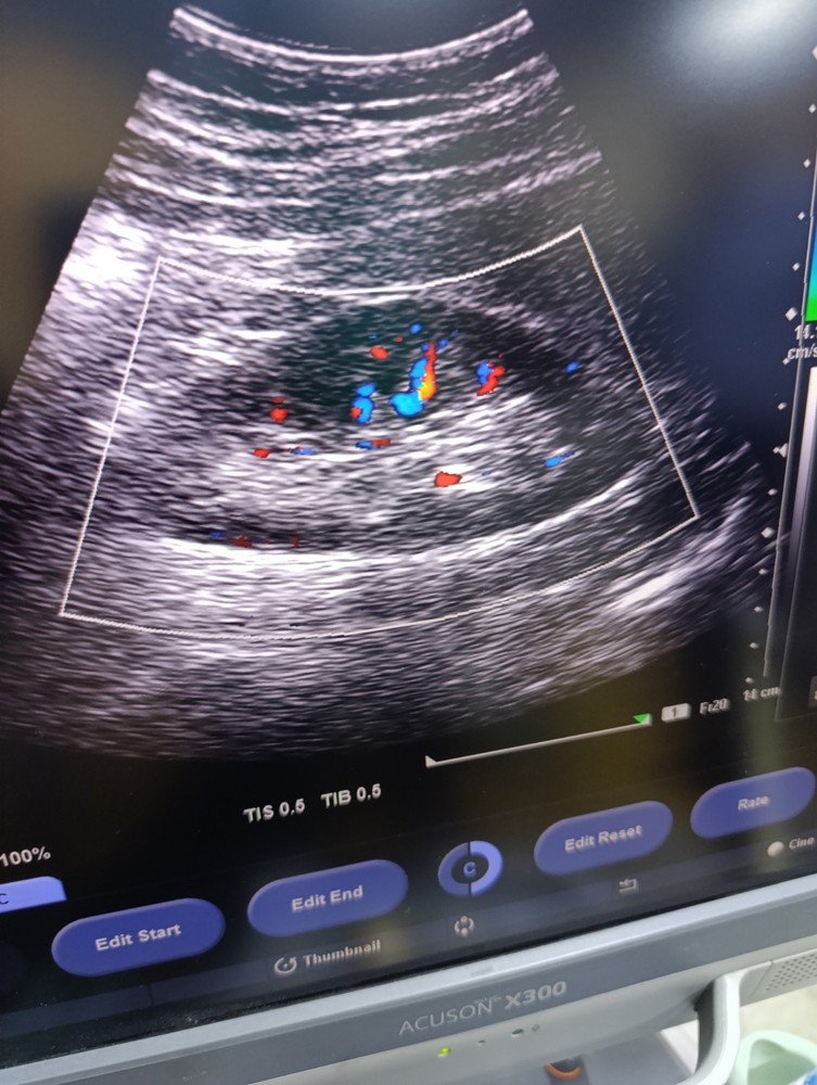 Siemens Convex Probe CH5-2
