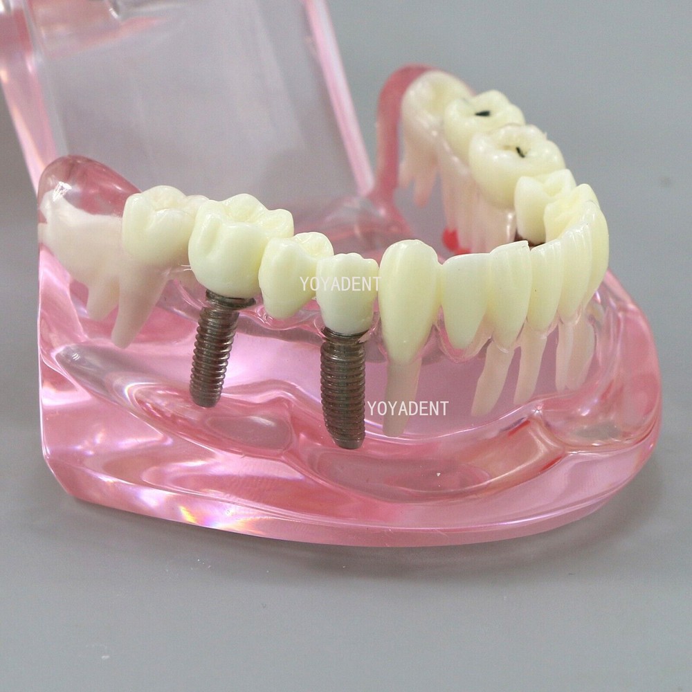 Multiple Types Dental Teaching Teeth Model Typodont Ortho Implant Practice Demo