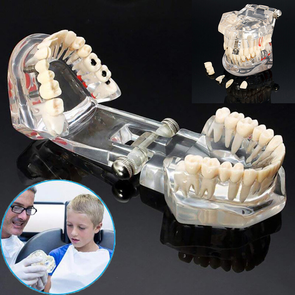 Dental Teeth Teaching Model Study Teach Implant Disease Analysis Removable Tooth