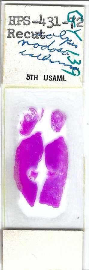 Human Salpingitis Isthmica Nodosa Pathology Microscope Slide