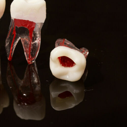 Dental Tooth Endo Root Canal Study Model For RCT Practice Blocks Pulp Cavity