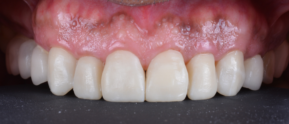 DLP SLA LCD 3d printer temporary teeth resin ..