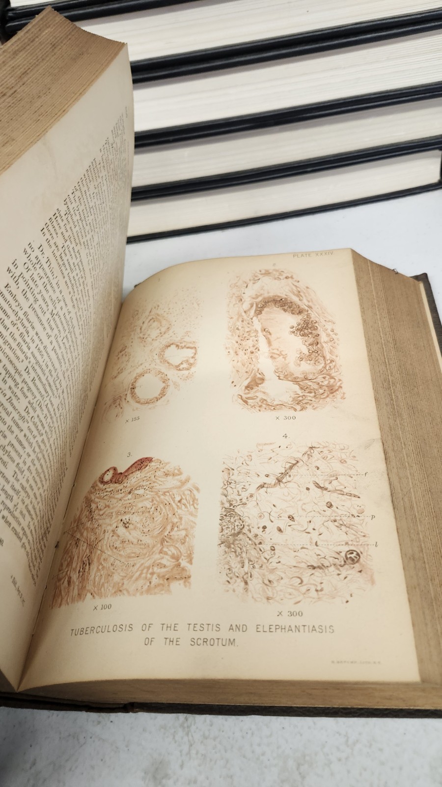 1886 International Encyclopaedia of Surgery John Ashhurst Jr Vol VI