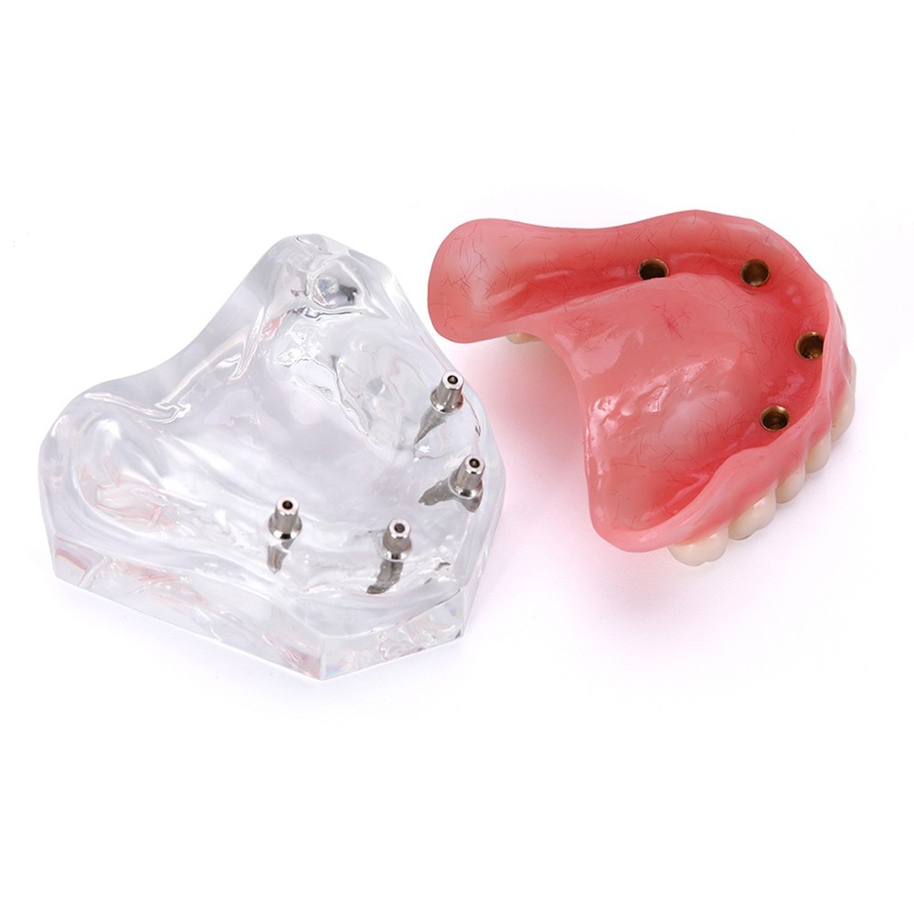 Dental Teeth Model Upper Lower Tooth 4 Implants Restoration Overdenture Model