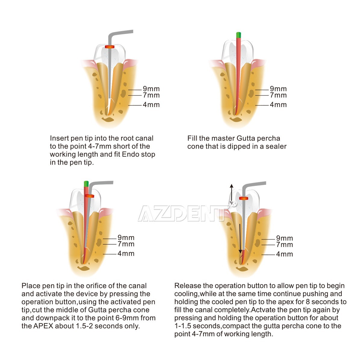 Sistema de obturación de gutapercha Dental pluma calefactora Endodoncia +2puntas