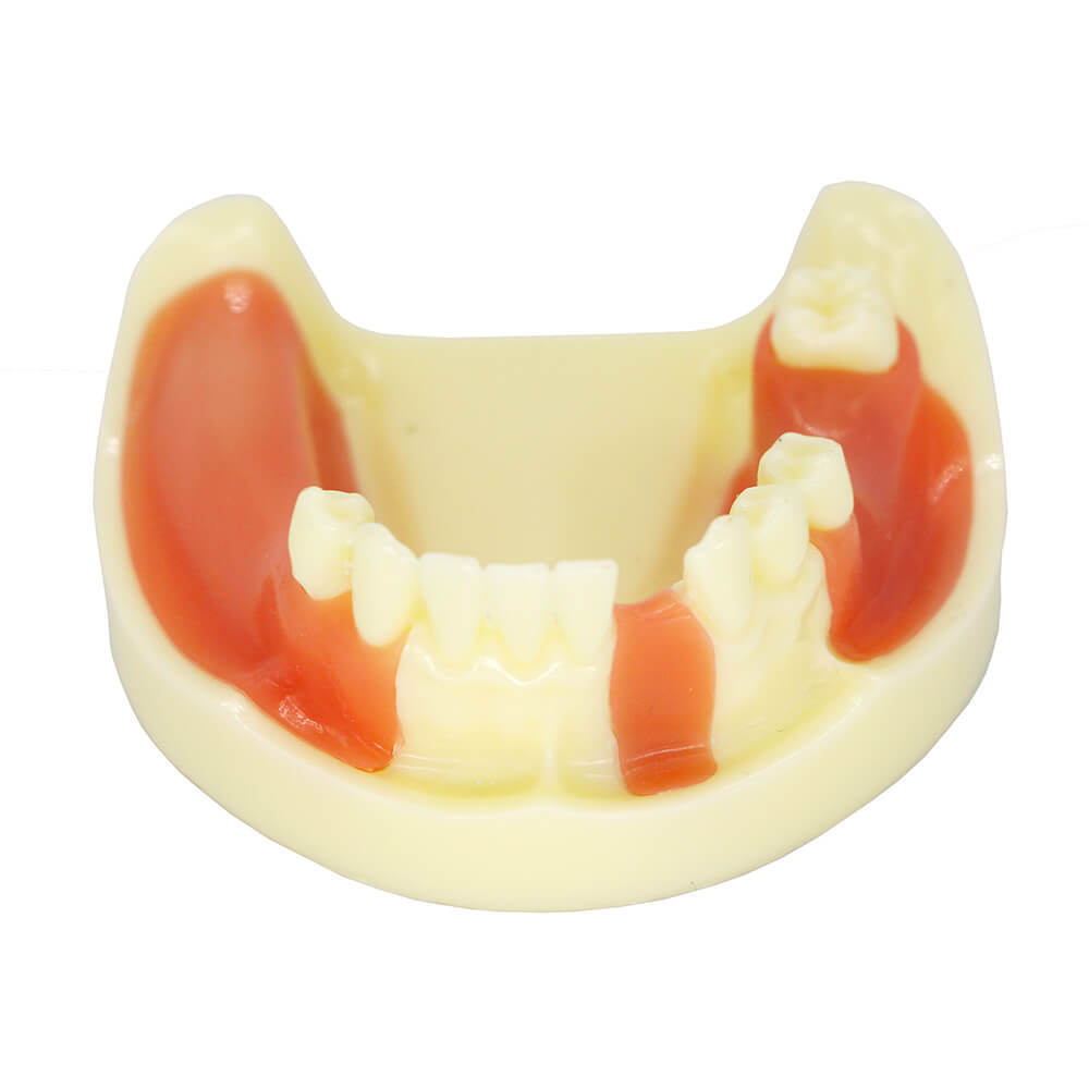 Dental Implant Training Model with Missing Teeth & Bone Loss Simulation