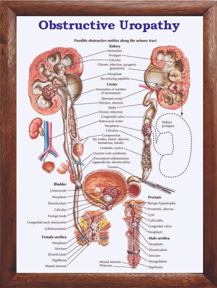 Obstructive Uropathy Chart 12x18 inches