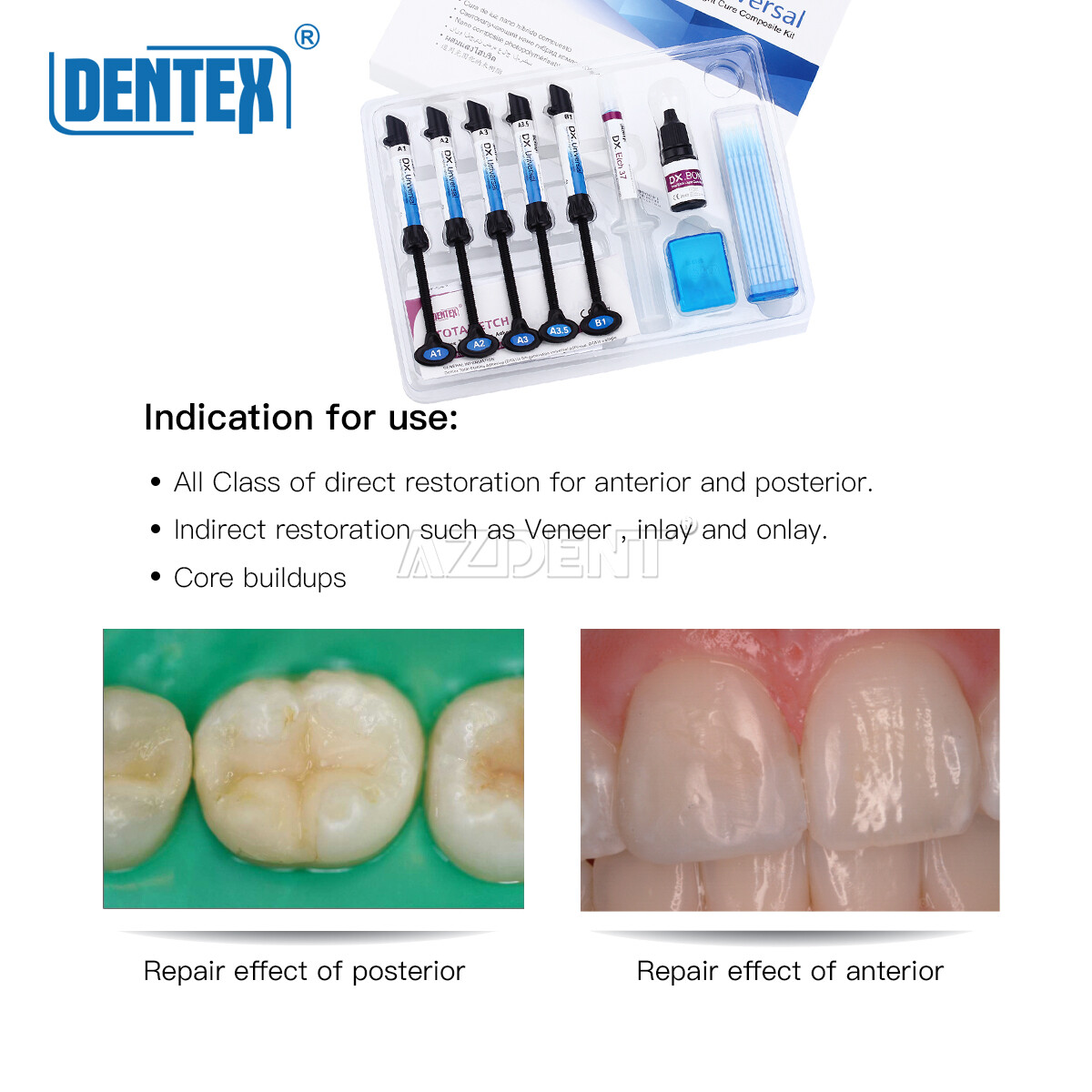 Dentex Dental Light Cure Hybrid Resin Composite Restoration 6 Syring Kit A1-B1