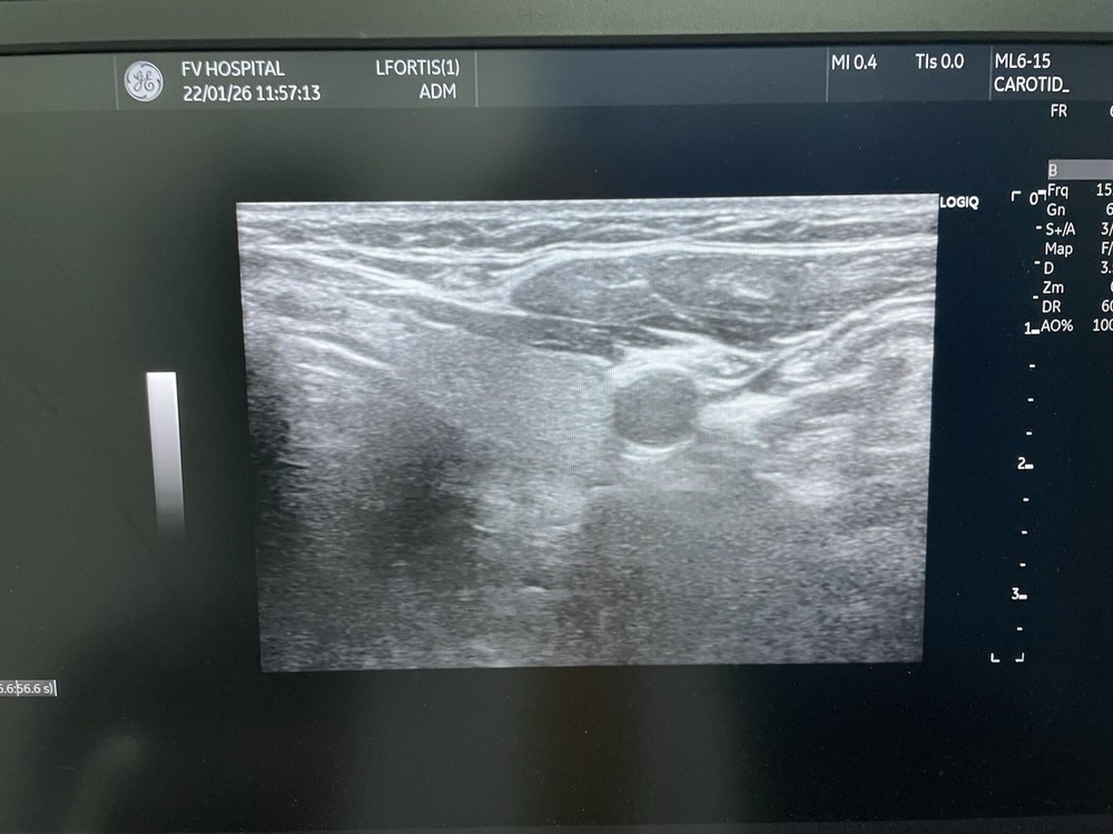 GE Ultrasound probe Linear ML6-15D