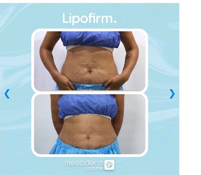 Lipofirm 10 Ampolletas