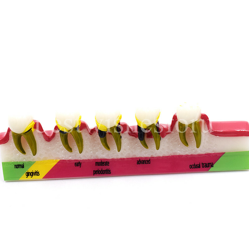 Dental Periodontal Disease Assort Developing Demonstration Teeth Study Model