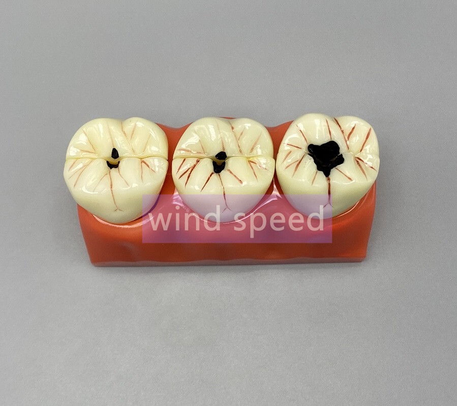 Dental Teaching Model 4 Times Caries Disassembling Comparations Implant Model