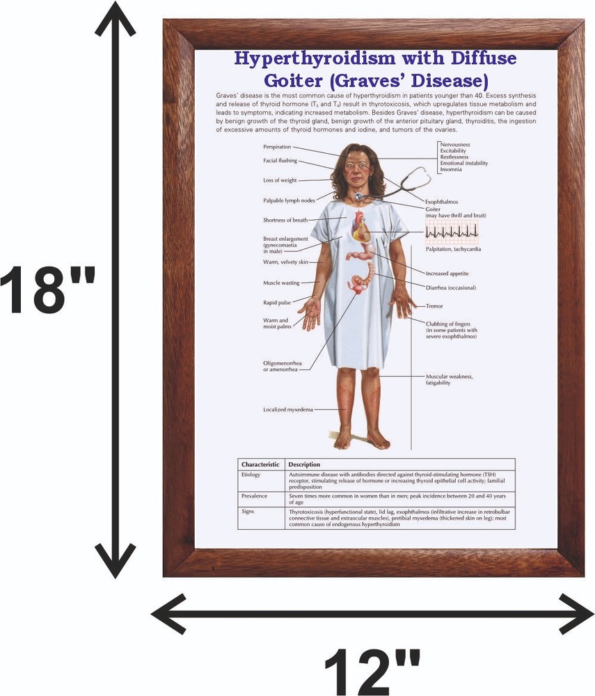 Hyperthyroidism with Diffuse Goiter Graves’ Disease) Chart 12x18 inches