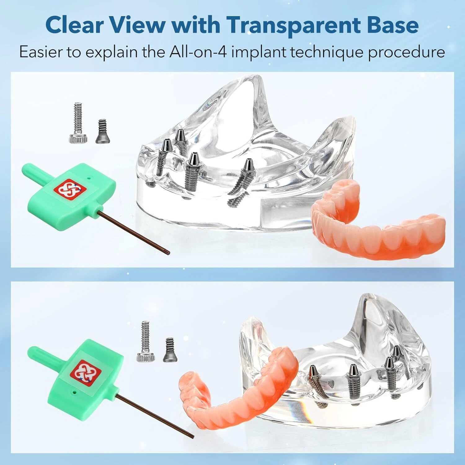 US Dental All-on-4 Overdenture Implant Model, Upper/Lower Jaw-Clear,With 4 Screw