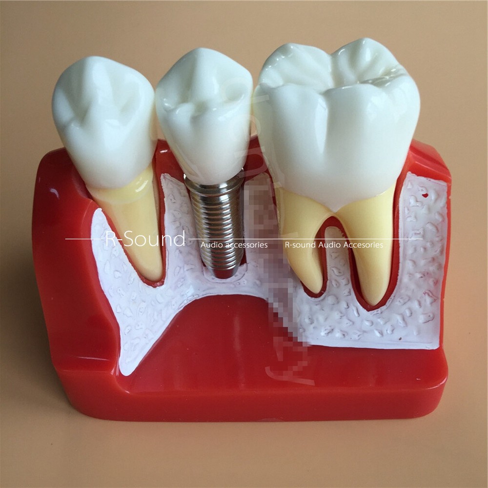 Dental Typodont Model Teaching Model Demonstration With Removable Teeth*