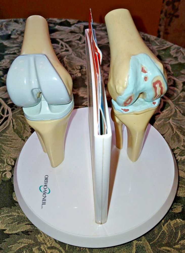 Anatstat ARTIFICIAL KNEE REPLACEMENT Medical Anatomical Skeleton DEMO MODEL