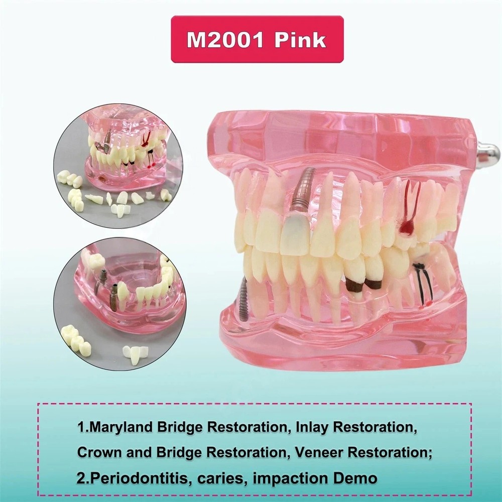 Dental Teeth Model Multiple Types Ortho Implant Practice Teaching Demo Model