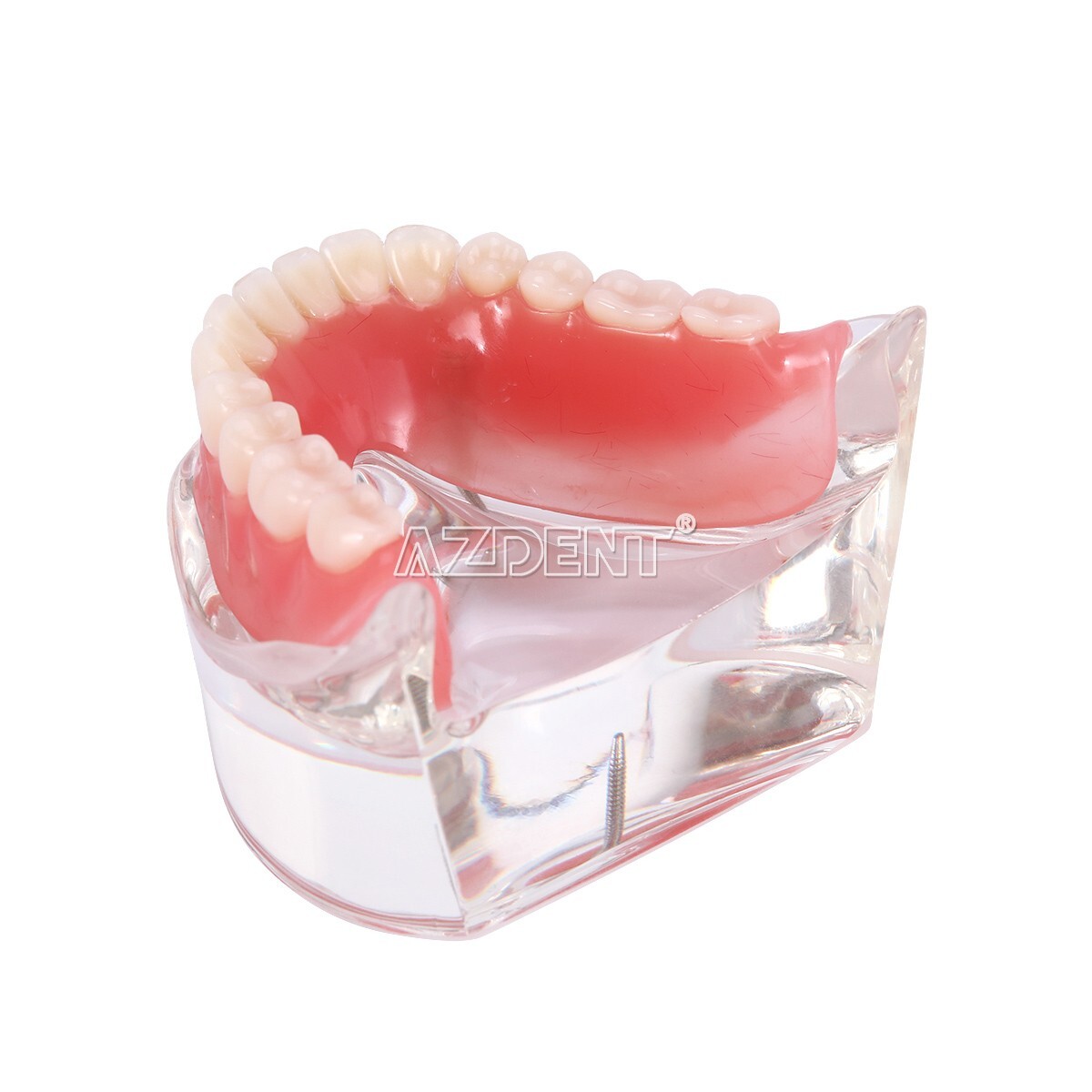 Dental Implant Teeth Model Demo Overdenture Restoration With Implants Lower