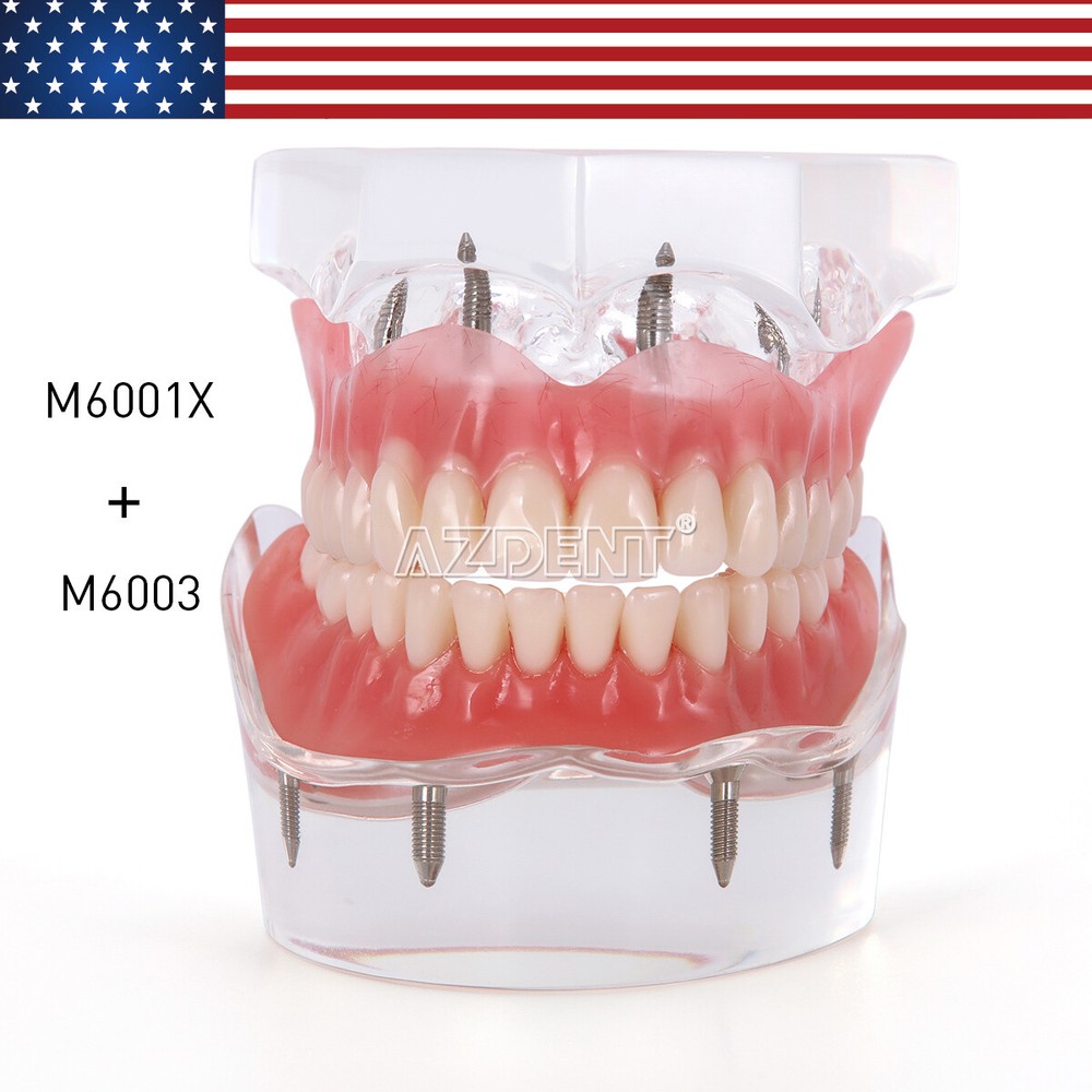Dental Implant Teach Study Model Demo Overdenture Typodont 4Implants Upper Lower
