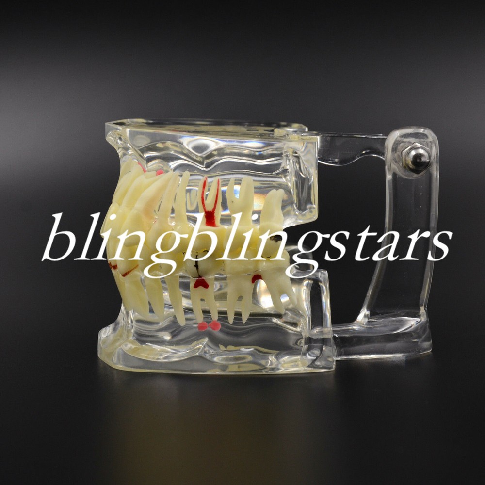 1 Pc Dental Pathological Disease Study Teeth Model Transparent Tooth Dentistry