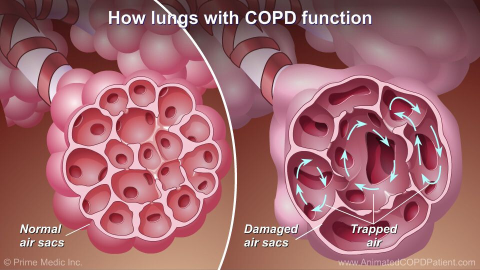 Serious Support for Asthma, Bronchitis, Emphysema, COPD - Opens Lung Airways.