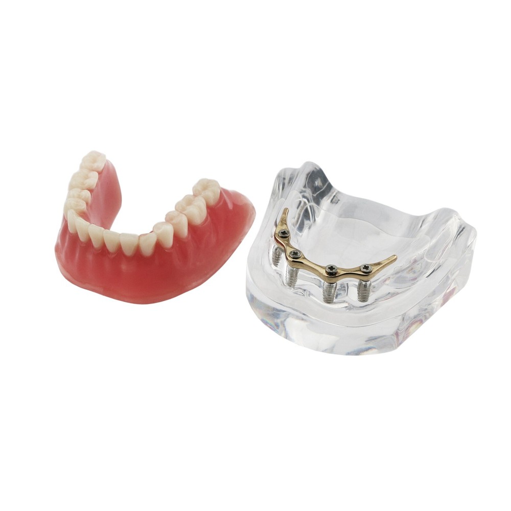 Multi Types Dental Typodont Teeth Model Implant Pathological Perio Practice Demo
