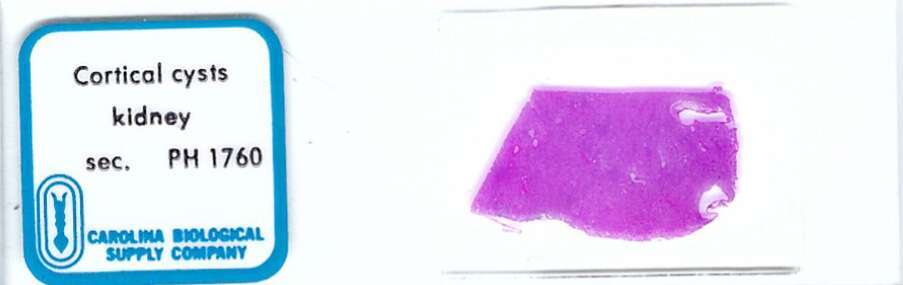 Human Kidney Cortical Cysts Pathology Microscope Slide