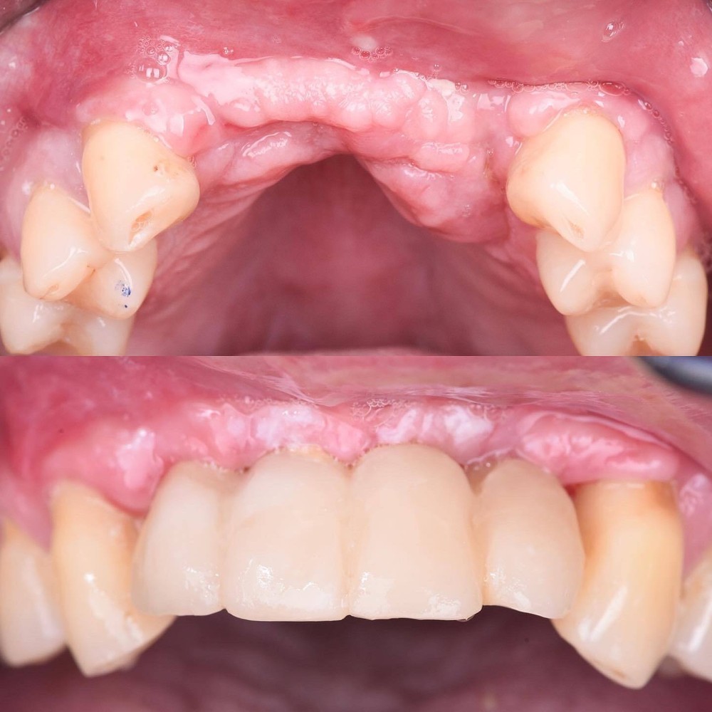 DLP SLA LCD 3d printer temporary teeth resin ..