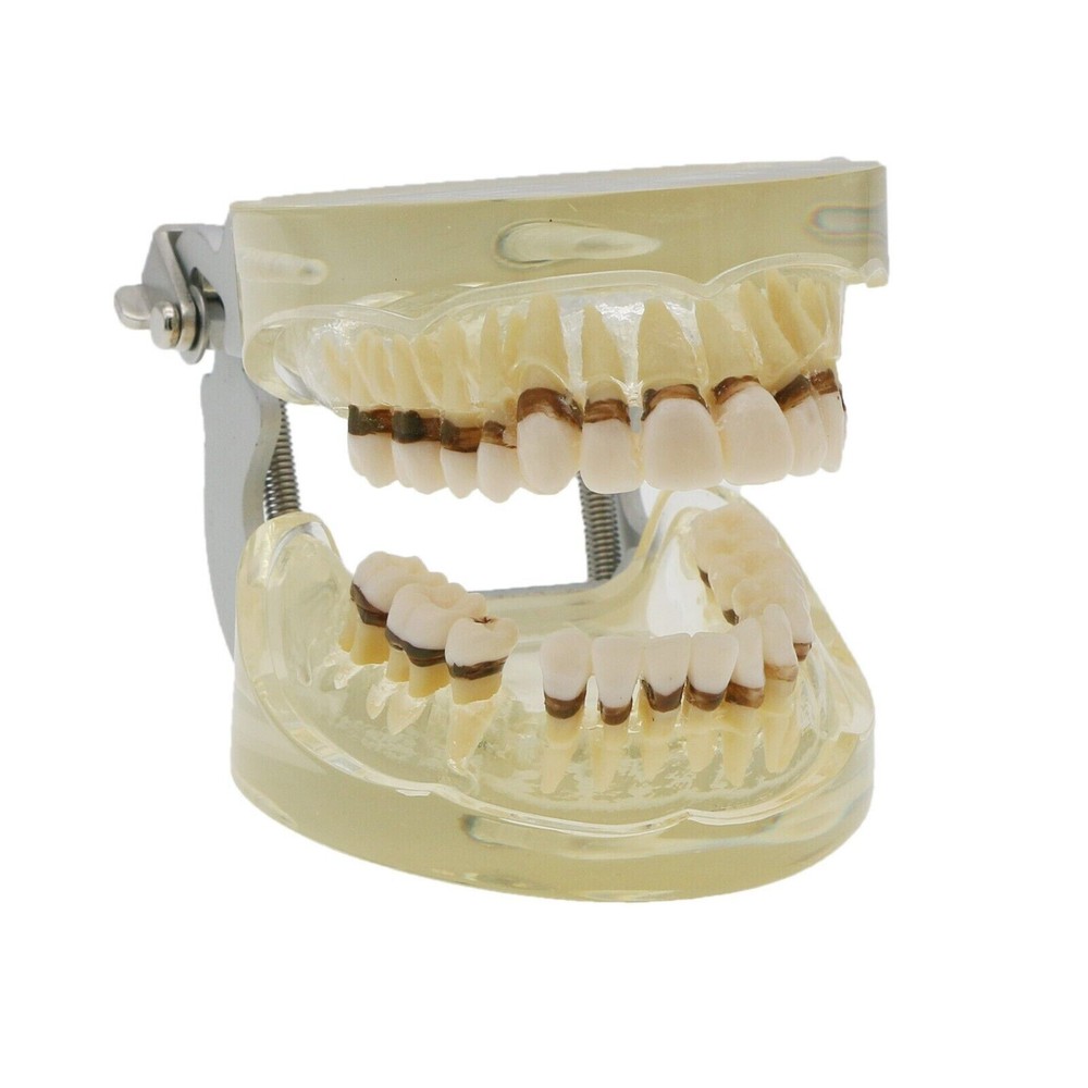 Dental Periodontal Pathological Disease M4017 Removable Teaching Study Model
