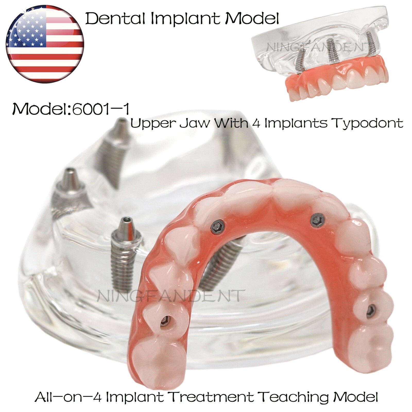 US Dental Implant All-on-4 Overdenture treatment Model Upper 4 Implants Clear