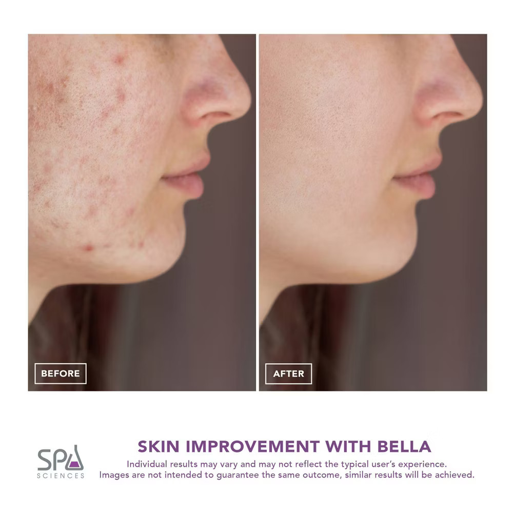 BELLA 3-in-1 Microderm Pore Extractor & Micro Mister White Marble