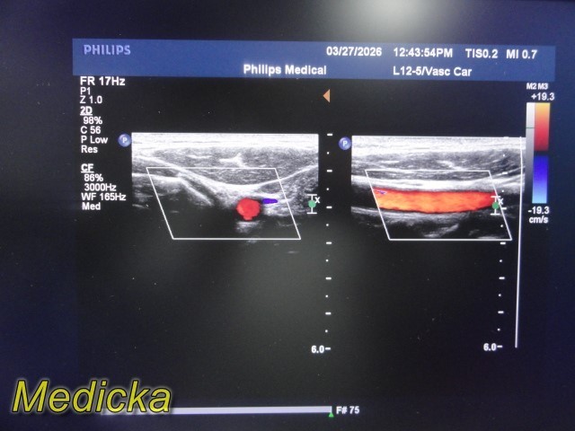 Philips L12-5 Linear Array Ultrasound Transducer *TESTED & WORKING* ~ 39679
