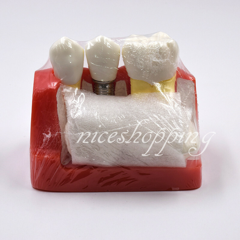 Dental Demonstration Teeth Model Implant Analysis Crown Bridge for Dentist