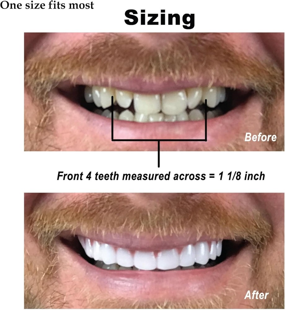 Easy Fitting Cosmetic Veneers - Comfortable Fit