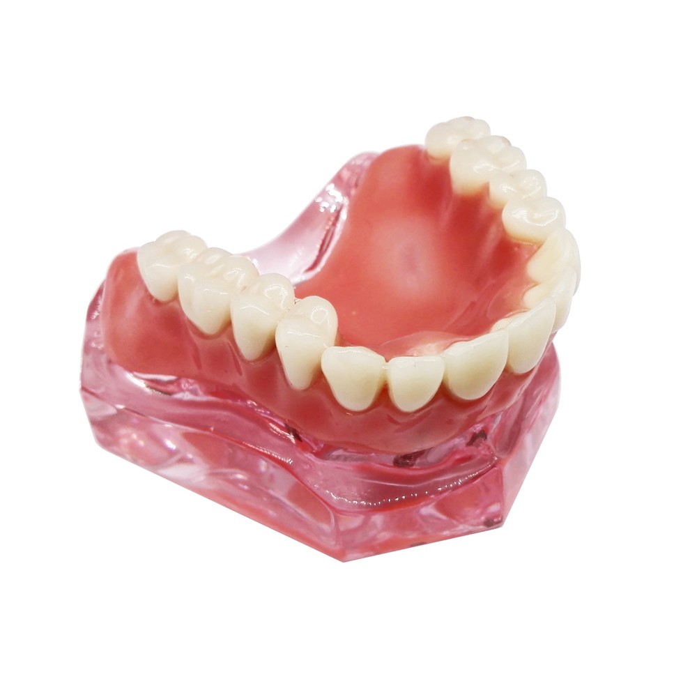 Dental Implant Teeth Model Demo Overdenture Restoration With 4 Implants Upper
