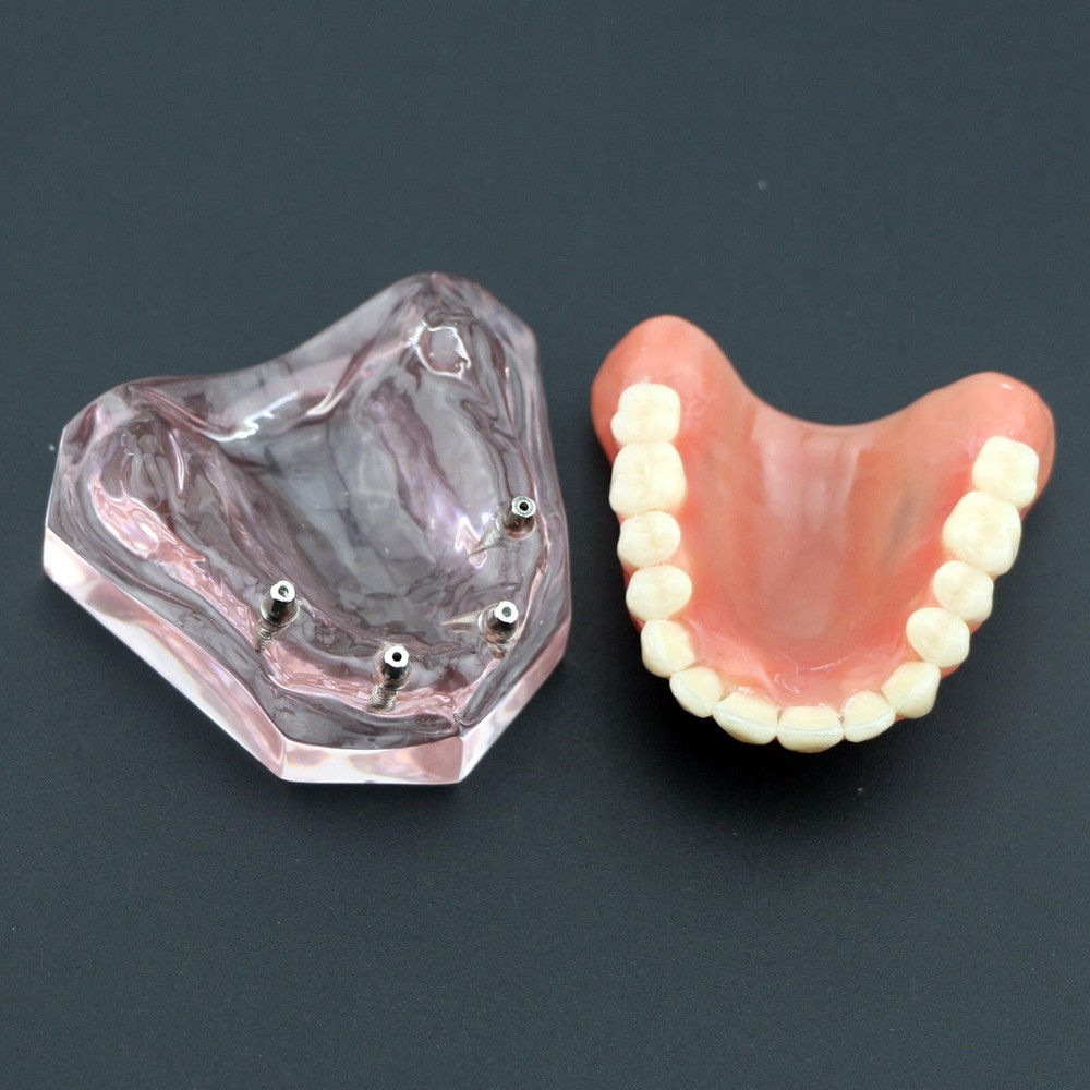 Dental Implant Overdenture Upper Superior Model Precision 4 Maxillary