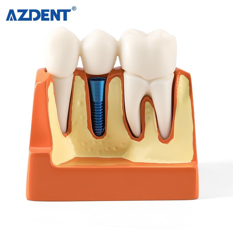 4 Times Dental Teeth Removable Model Implant Teaching Learning Tool Analysis