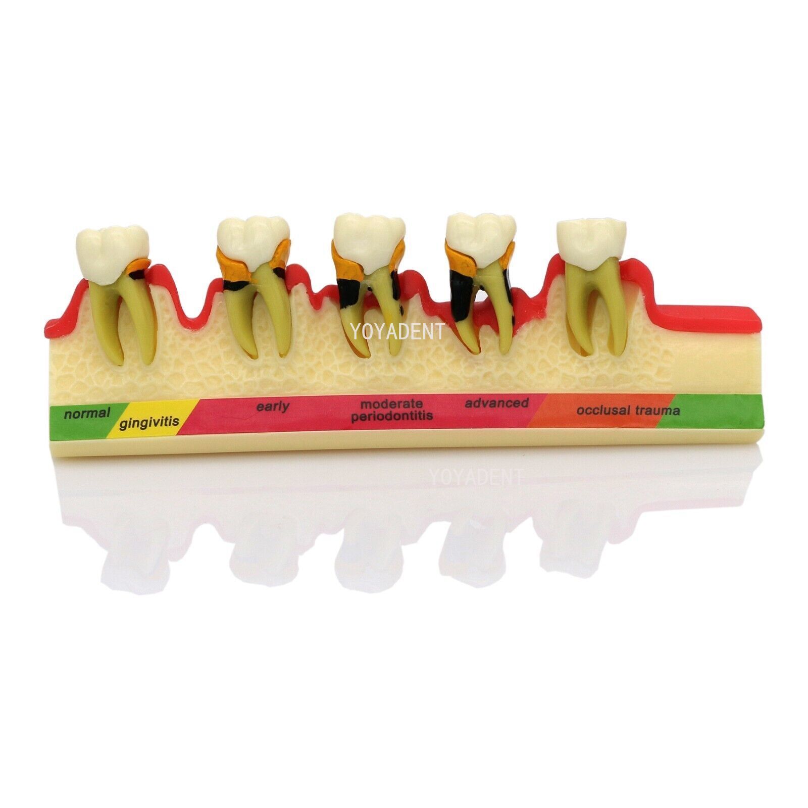 Dental Model Periodontal Disease Assort Teeth Model Endodontic Teaching Demo US