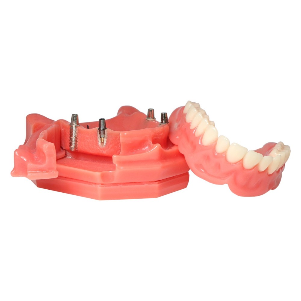 Dental Multi Typodont Teeth Model for Implant Pathological Restoration Practice