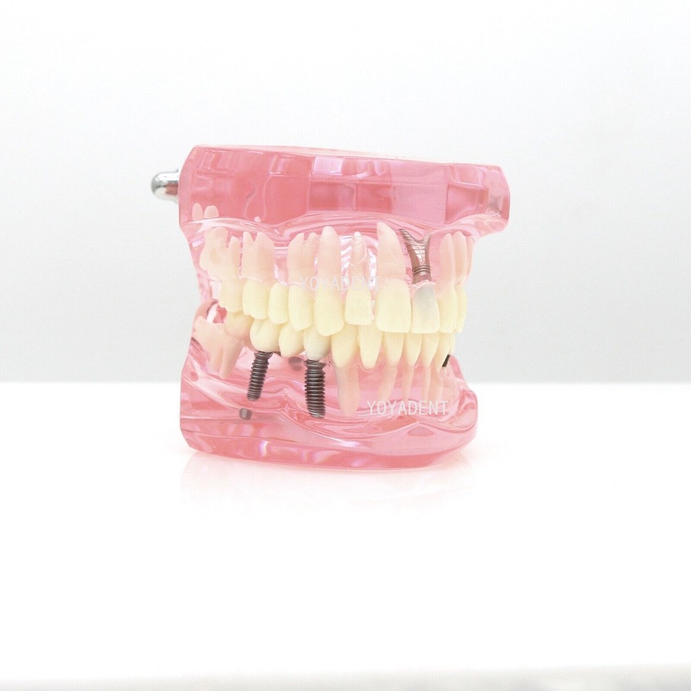 Multiple Types Dental Teaching Teeth Model Typodont Ortho Implant Practice Demo