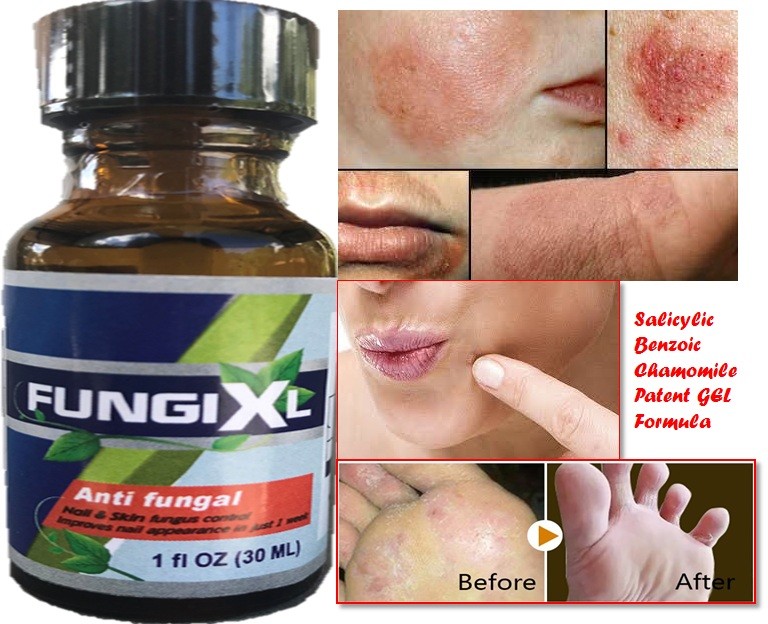 FUNGI XL ANTIFUNGAL CL EXTRA STRENGTH FUNGUS NAILS Support