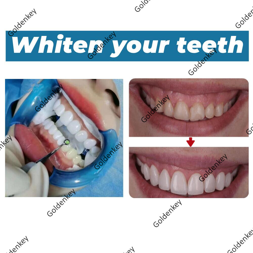Dental Whiten Composite Resin Light Cure Bright White Veneer Hybrid Aesthetic