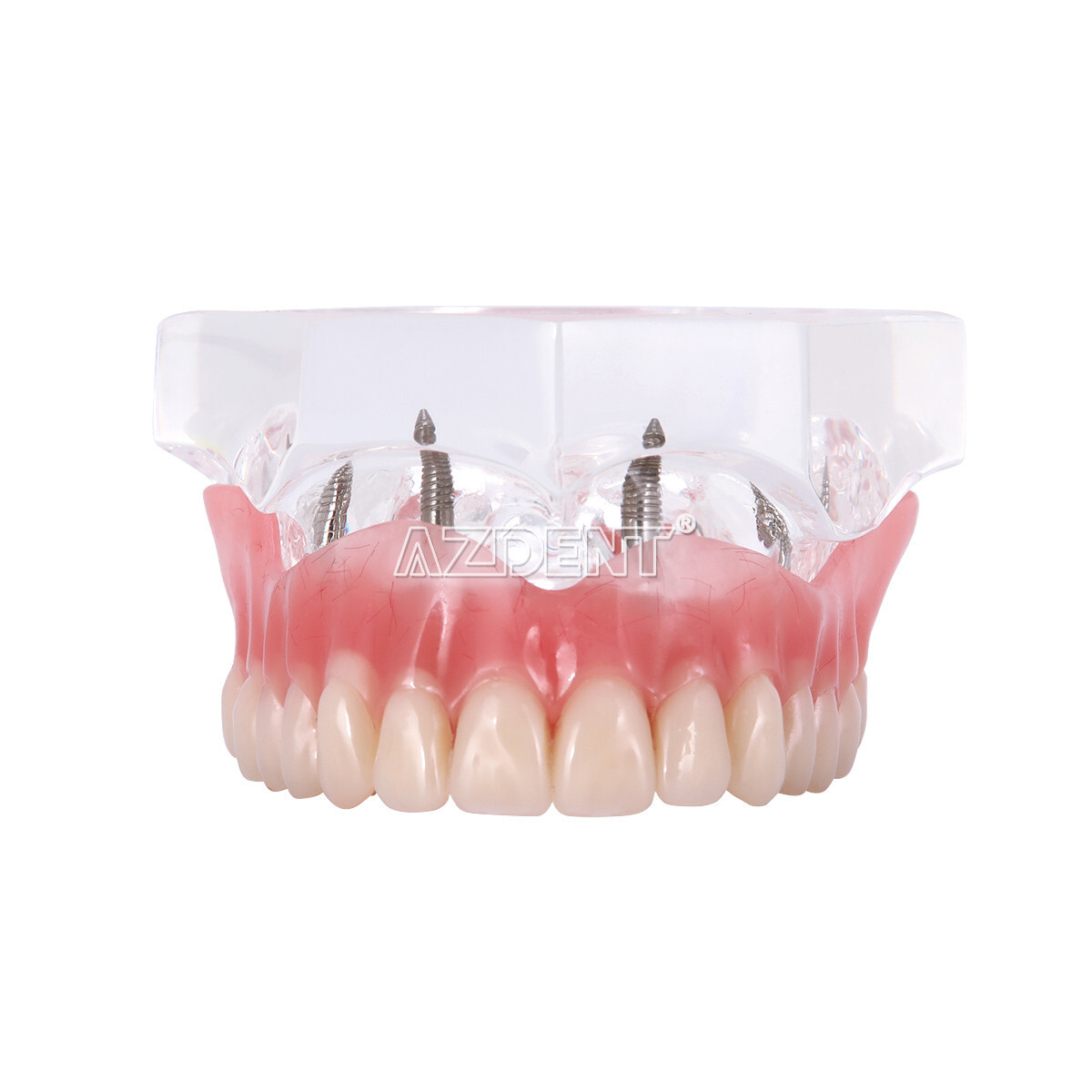 Dental Overdenture Implant Teeth Model Denture with implant Demonstration Clear