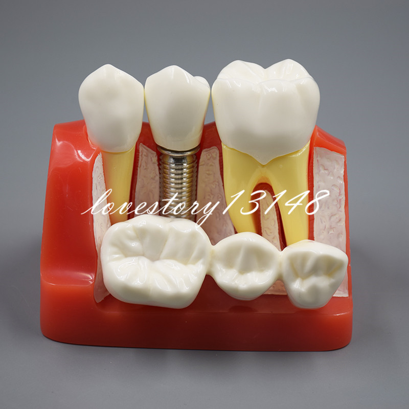 Dental Implant Analysis Crown Bridge Demonstration Teeth Tooth Study Model