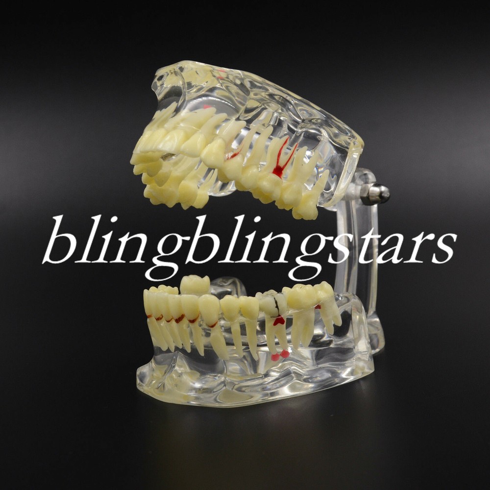 1 Pc Dental Pathological Disease Study Teeth Model Transparent Tooth Dentistry