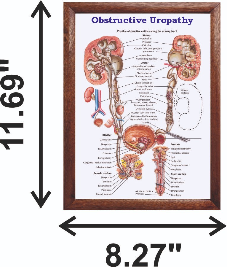 Obstructive Uropathy Chart 12x18 inches