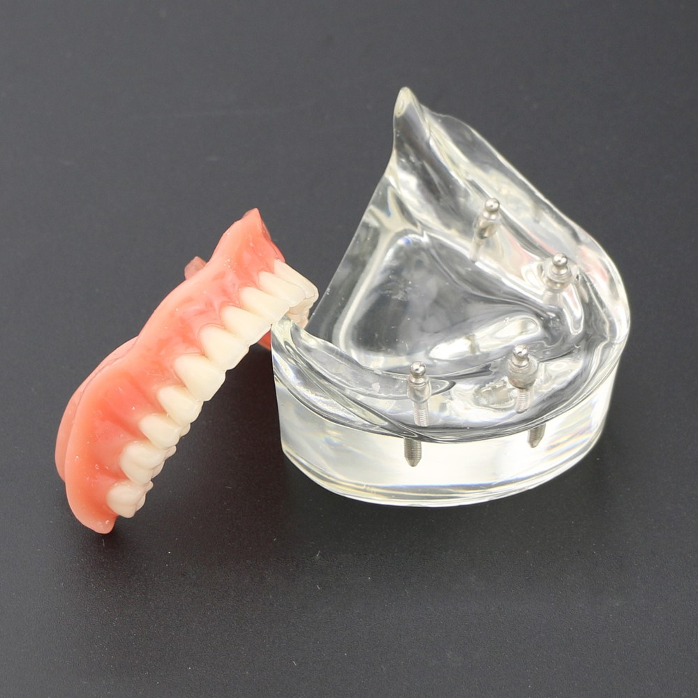 Dental Typodont Lower Teeth Demo Study Model Overdenture Inferior 4 Implants
